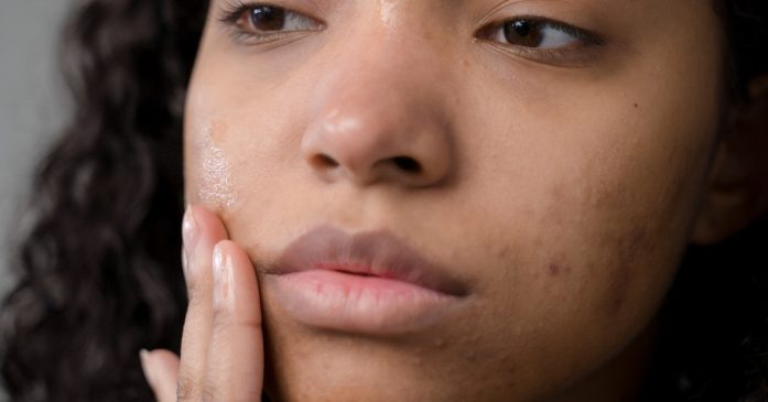 Common ailments scheme wales for acne