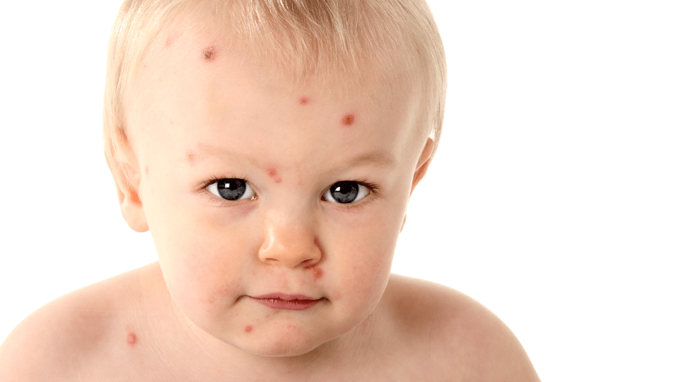 Chicken Pox Treatments